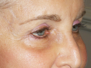 Female Eyelid Surgery