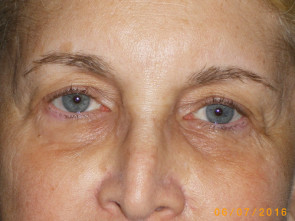 Female Eyelid Surgery