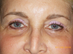 Female Eyelid Surgery