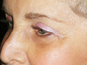 Female Eyelid Surgery