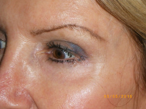 Female Eyelid Surgery