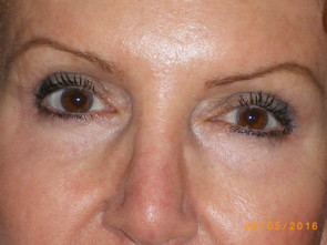 Female Eyelid Surgery