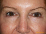 Female Eyelid Surgery