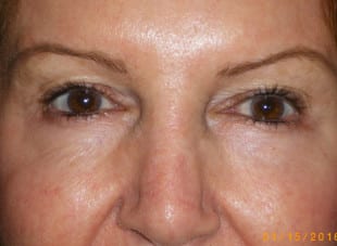 Patient 110 - Before View 
