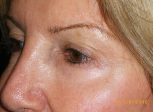 Patient 110 - Before View 
