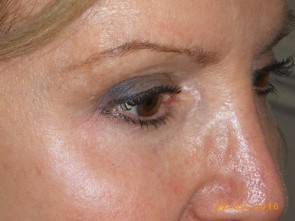 Female Eyelid Surgery