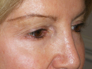 Female Eyelid Surgery