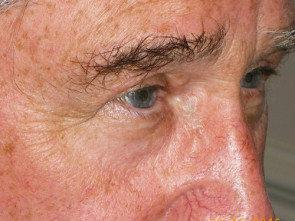 Male Eyelid Surgery