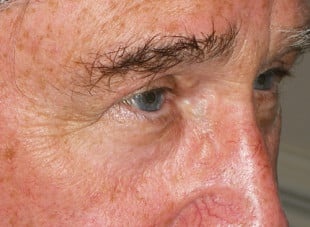 Patient 43 - After View 