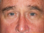 Male Eyelid Surgery