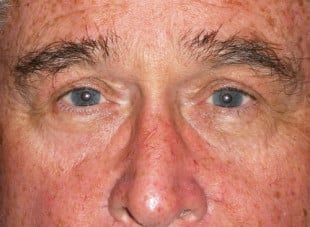Patient 43 - After View 