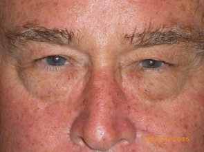 Male Eyelid Surgery