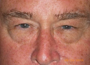 Patient 43 - Before View 