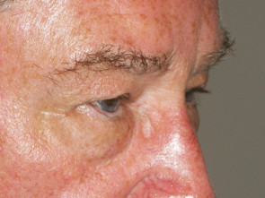 Male Eyelid Surgery