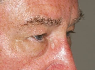 Patient 43 - Before View 