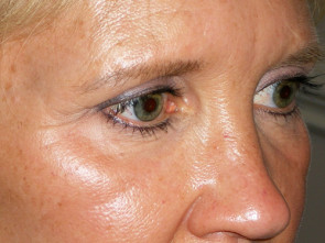 Female Eyelid Surgery