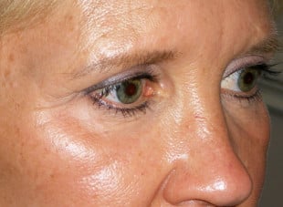 Patient 100 - After View 