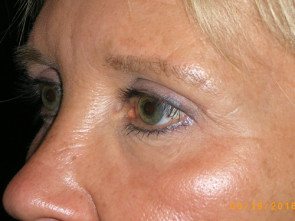 Female Eyelid Surgery