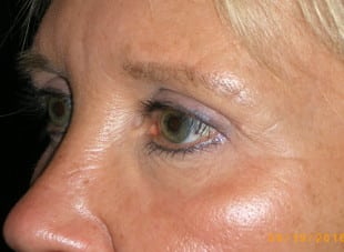Patient 100 - After View 