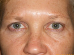 Female Eyelid Surgery