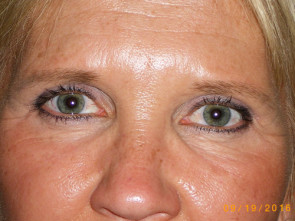 Female Eyelid Surgery