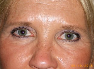 Patient 100 - After View 