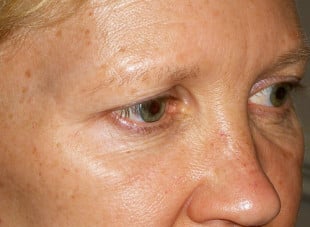 Patient 100 - Before View 
