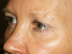 Female Eyelid Surgery