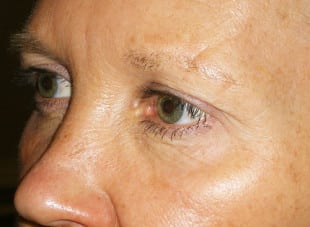 Patient 100 - Before View 
