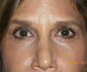 Female Eyelid Surgery