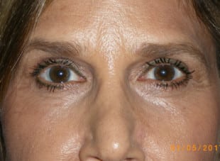 Patient 93 - After View 