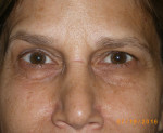 Female Eyelid Surgery