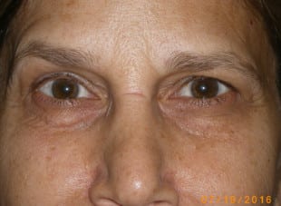 Patient 93 - Before View 