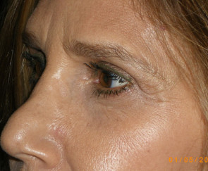 Female Eyelid Surgery