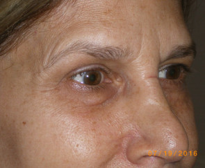 Female Eyelid Surgery