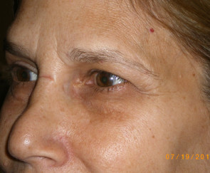 Female Eyelid Surgery