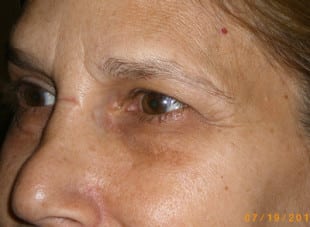 Patient 93 - Before View 