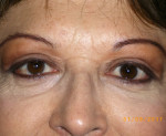 Female Eyelid Surgery