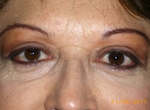 Patient 69 - After View 