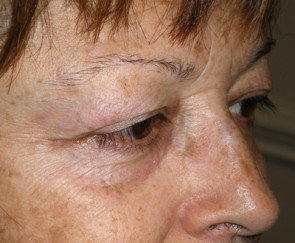 Female Eyelid Surgery