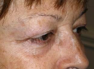 Patient 69 - Before View 