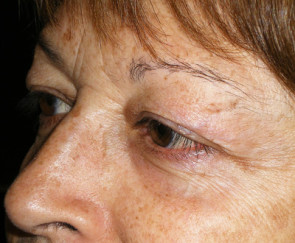 Female Eyelid Surgery