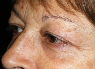 Patient 69 - Before View 