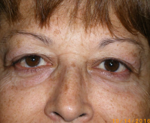 Female Eyelid Surgery