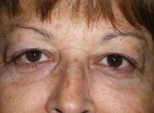 Patient 69 - Before View 