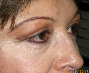 Female Eyelid Surgery