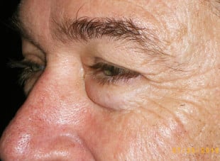 Patient 31 - Before View 