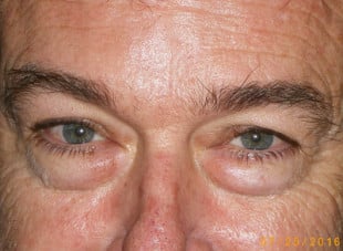 Patient 31 - Before View 