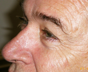 Male Eyelid Surgery