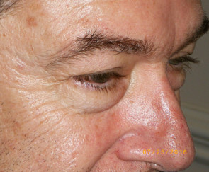 Male Eyelid Surgery